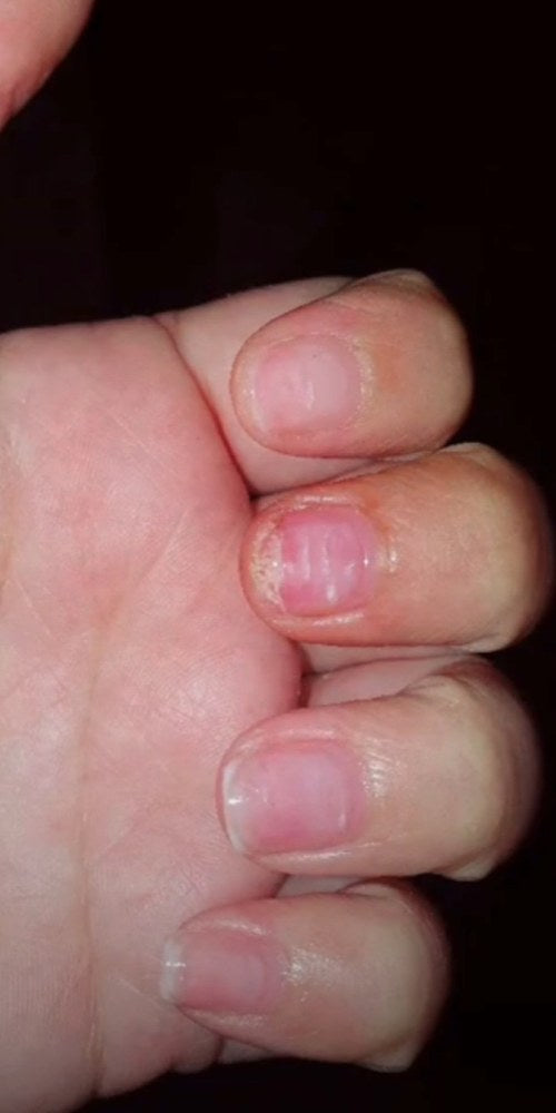 Nails before using Radiant nail growth oil: short, ridged and dry