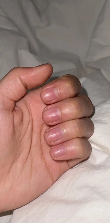 Nails before using Radiant nail growth oil: short, ridged nails