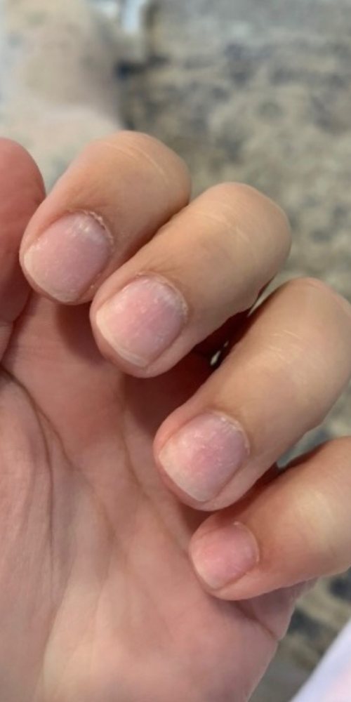 Nails before using Radiant nail growth oil