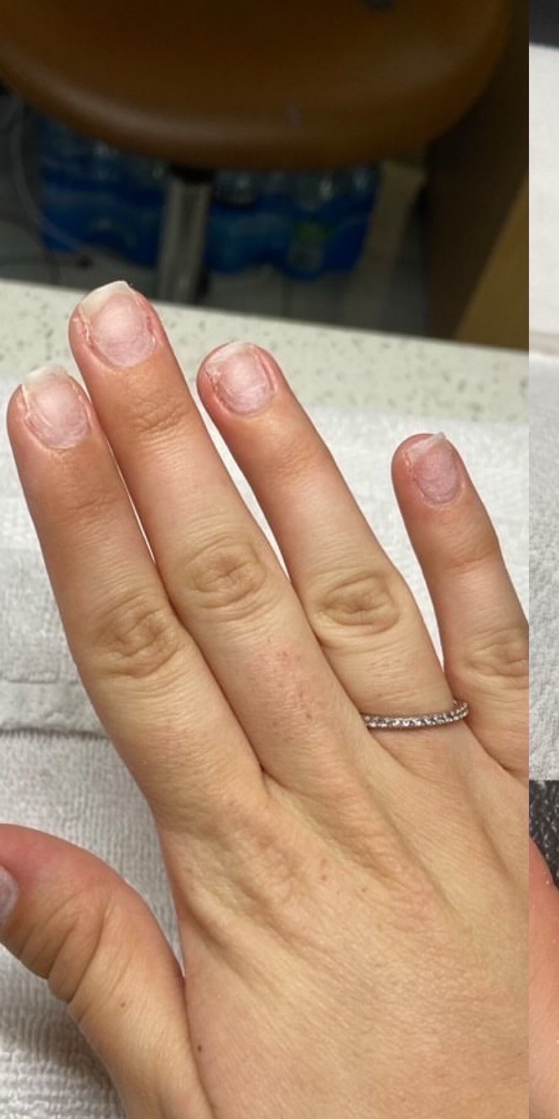 Customer 5, Nails before using Radiant nail growth oil